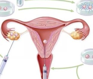 三代试管基因筛查夫妻都要做吗？比常规检测更准确